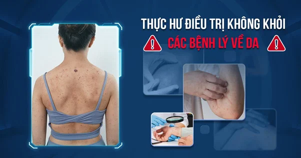 Thực hư về điều trị “không khỏi” các bệnh lý về da